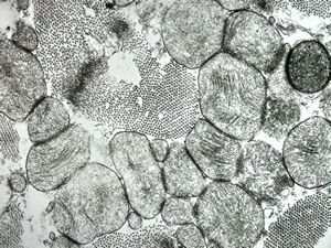 M,15y. | clin. susp. cardiomyopathy - left ventricle